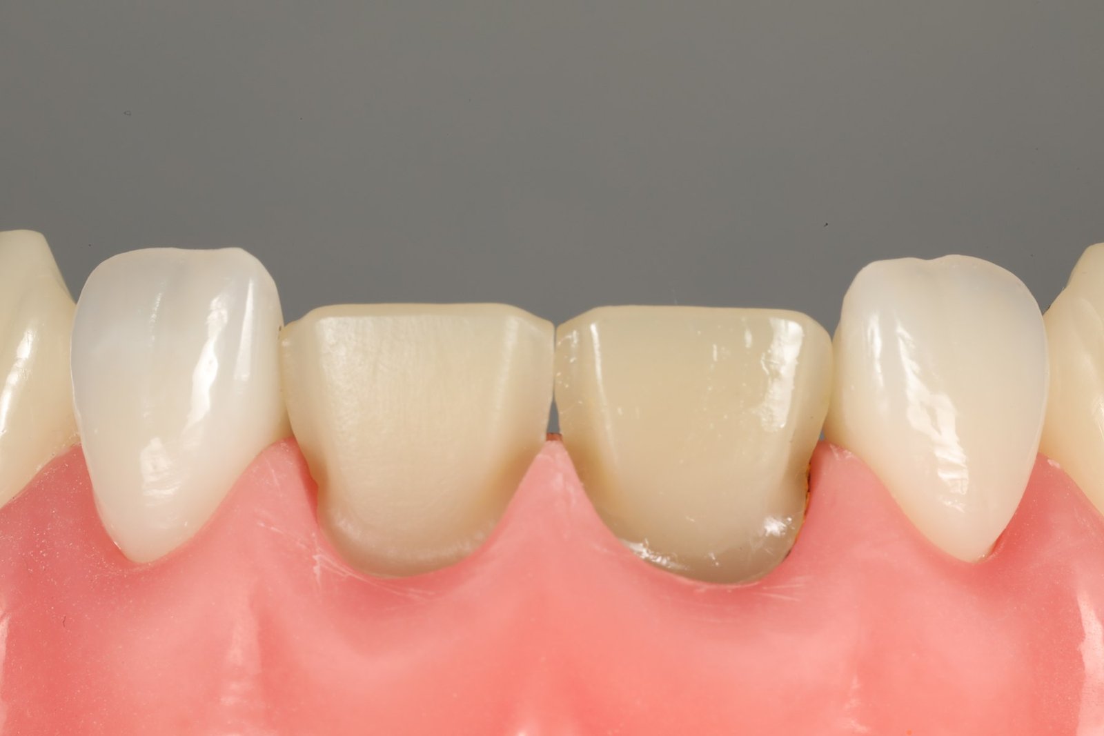 Etapa de preparo de facetas em dentes escurecidos