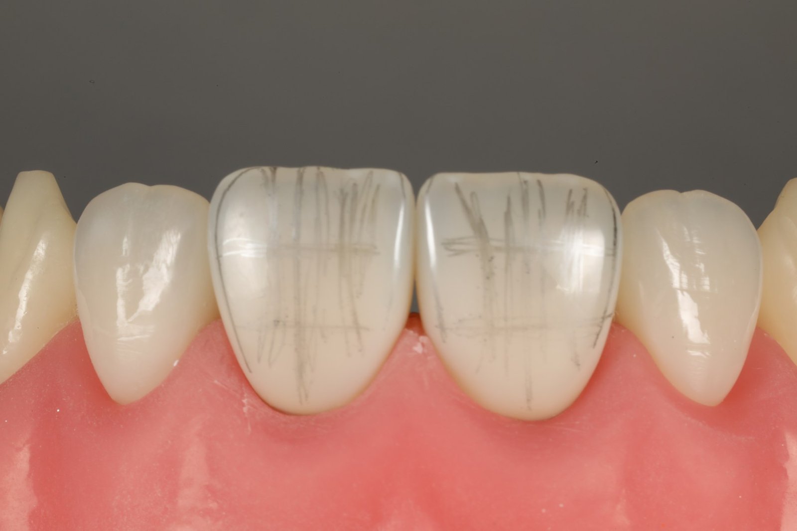 Anatomia das facetas em dentes escurecidos
