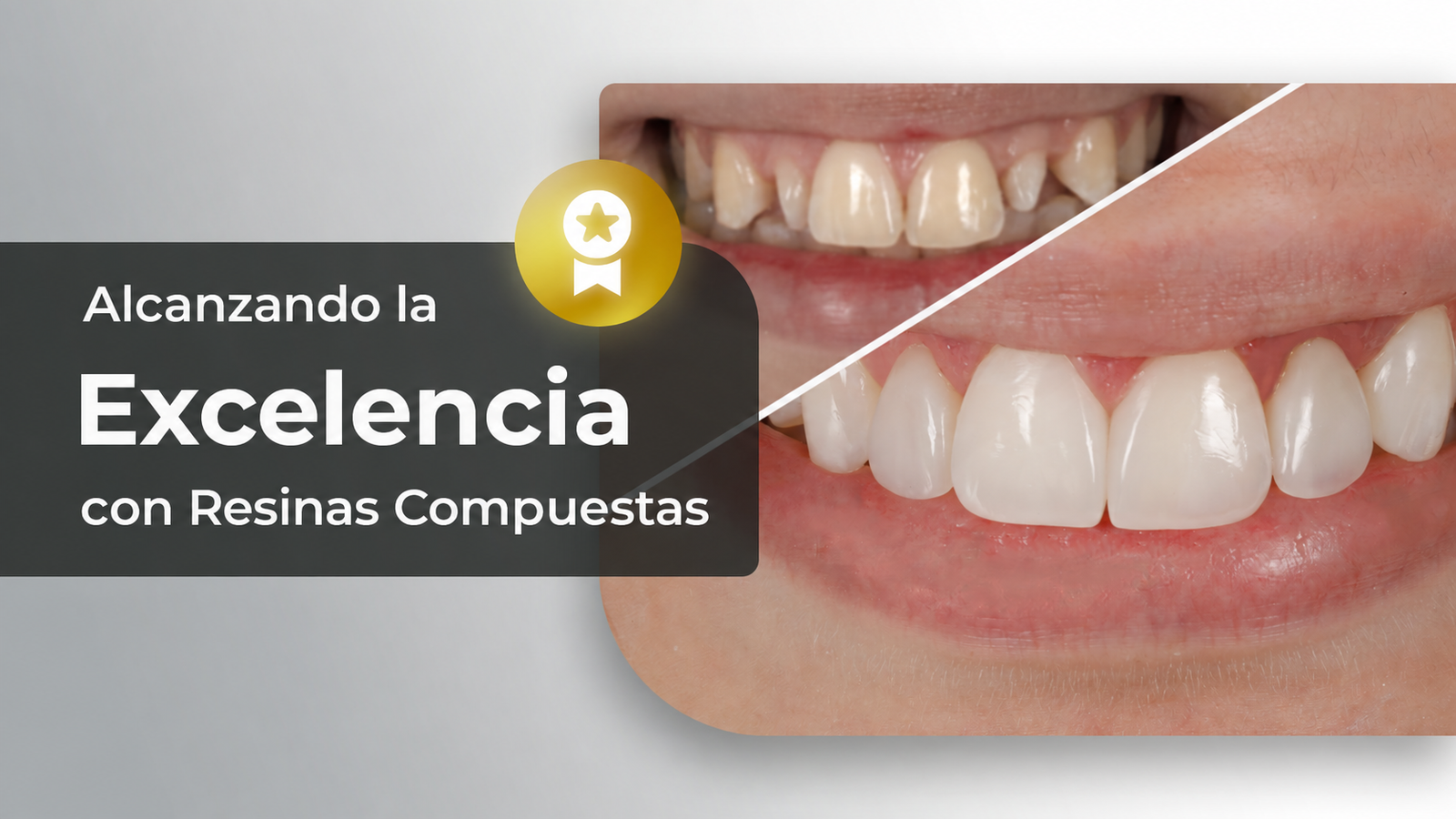 Alcanzando la Excelencia con Resinas Compuestas