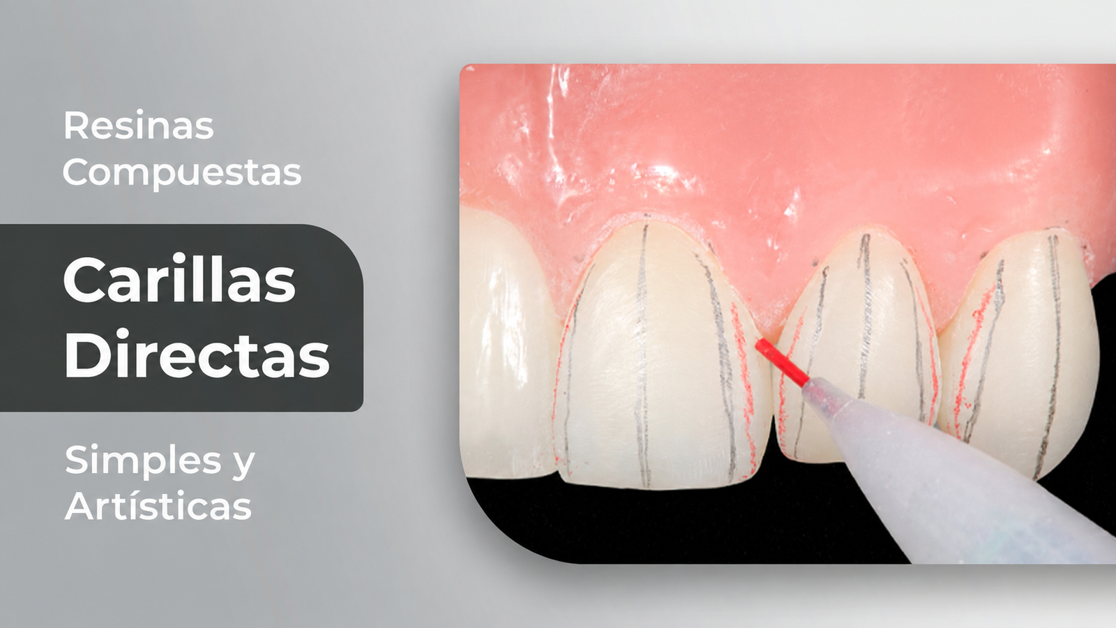 Carillas Directas en Resinas Compuestas: Simples y Artísticas